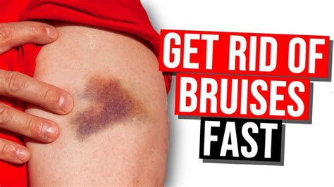 how to stop bruises from itching