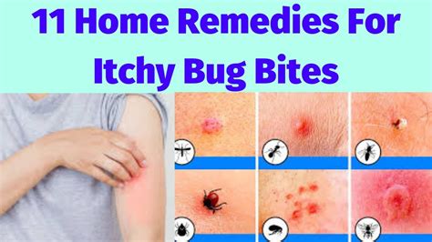 how to stop itchy skin from bug bites