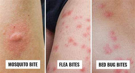 how to tell bed bug bites from other bites