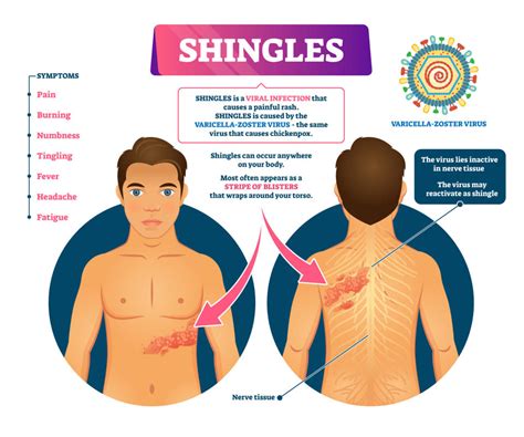 how to tell if shingles are healing