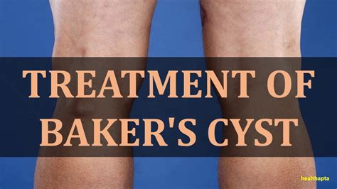 hw to treat baker cyst permantly Doc