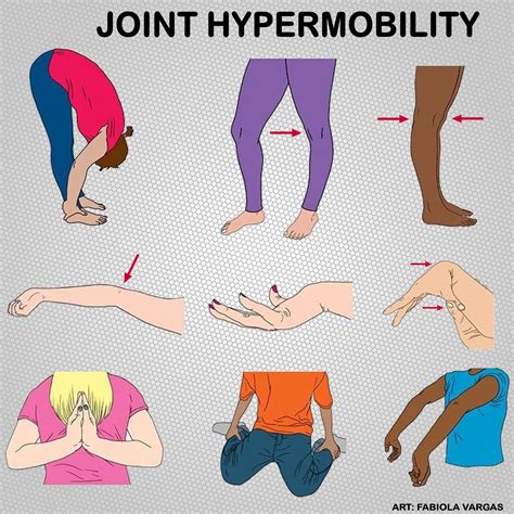 hypermobility of joints Kindle Editon