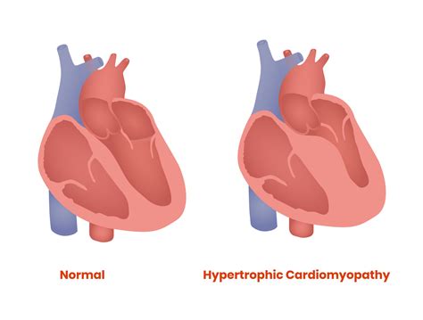 hypertrophic obstructive cardiomyopathy Epub