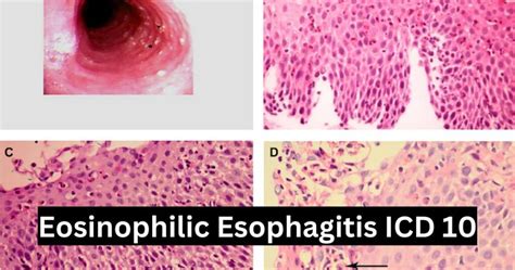 icd 10 eosinophilic esophagitis