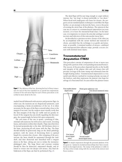 icd9 code for toe amputation Reader