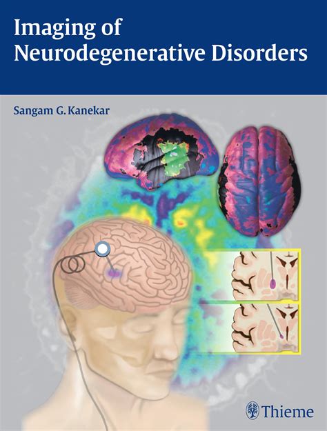 imaging neurodegenerative disorders sangam kanekar Kindle Editon