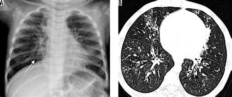 imaging of pulmonary infections Reader