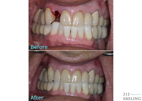 implant dentistry new york