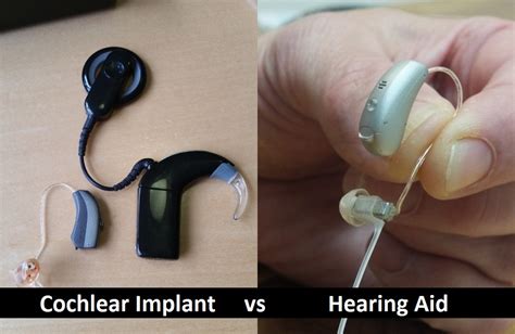 implantable hearing devices other than cochlear implants Doc