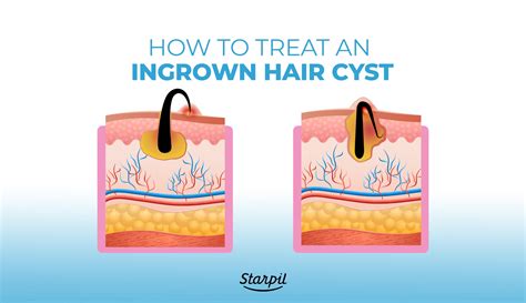 Ingrown Hair Cysts