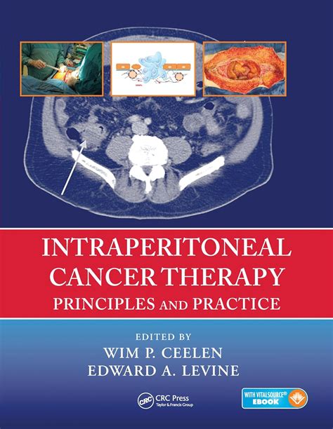 intraperitoneal cancer therapy principles practice Reader