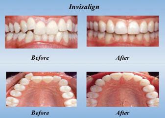 invisalign how long does it take