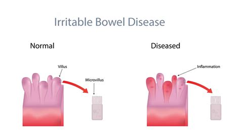 irritable bowel in cats