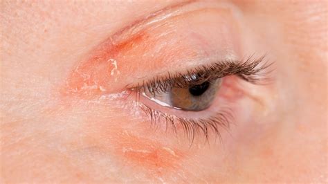 irritated skin around eyes