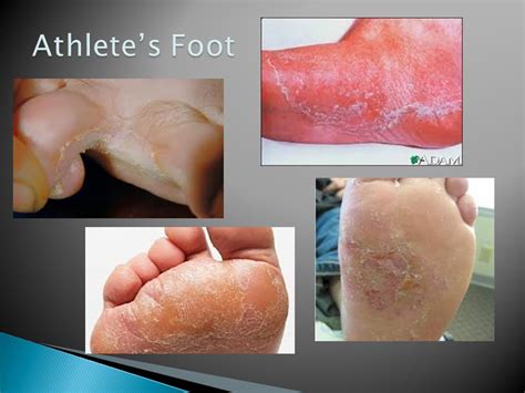 is athlete's foot contagious to others