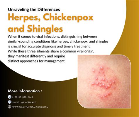 is shingles the same as herpes