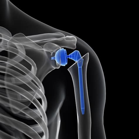 joint replacement in the shoulder and elbow PDF