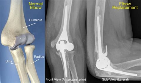 joint replacement in the shoulder and elbow PDF