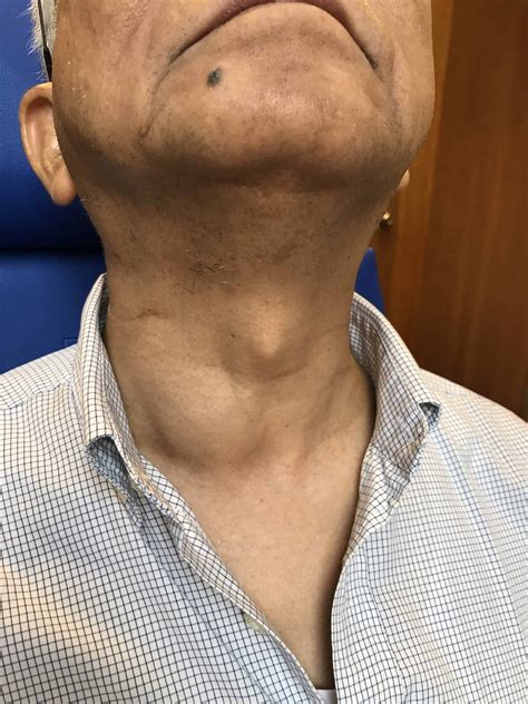 knot on left side of neck