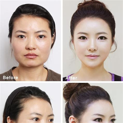 korean plastic surgery before and after