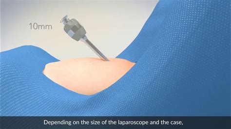 laparoscopic entry laparoscopic entry Reader