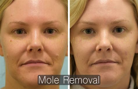 laser mole removal near me