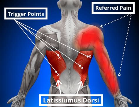 latissimus dorsi muscle pain