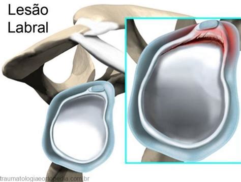 lesao labral