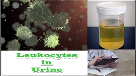 leukocytes and protein in urine