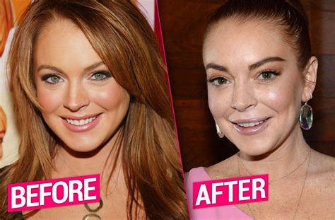 lindsay lohan plastic surgery