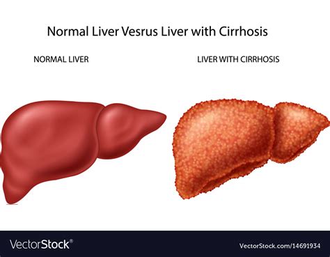 liver bigger than normal