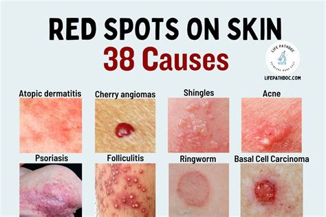 liver cancer red spots on skin