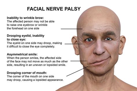 living with bells palsy PDF