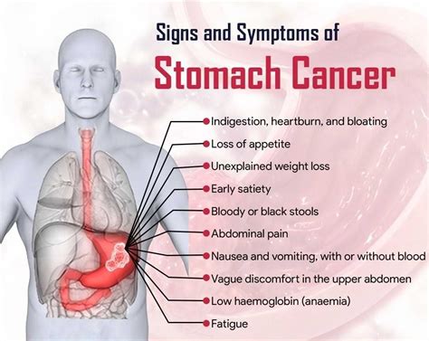 lump in the abdomen cancer