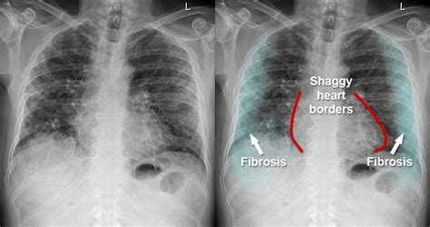 lung scarring from pneumonia