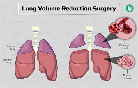 lung volume reduction surgery for emphysema Epub