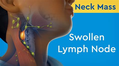 lymph nodes in neck swollen and painful on one side