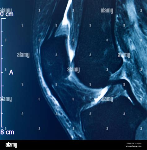 magnetic resonance imaging in orthopedic sports medicine PDF