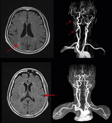 magnetic resonance imaging in stroke Reader