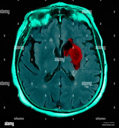 magnetic resonance imaging in stroke Reader