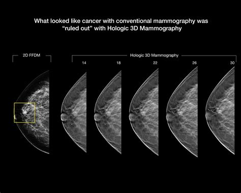 mammographic imaging mammographic imaging Doc