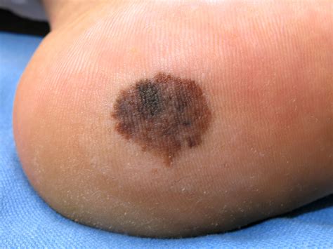 melanoma lenticular