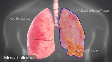 mesothelioma