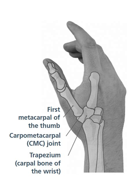 metacarpal pain manual guide PDF