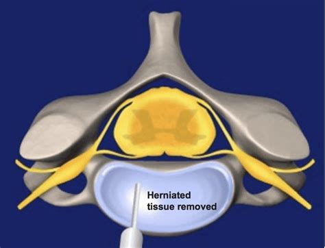 minimally invasive herniated disc repair PDF