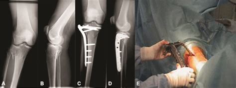 minimally invasive plate osteosynthesis mipo minimally invasive plate osteosynthesis mipo PDF