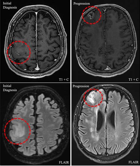 mri brain with and without contrast cpt