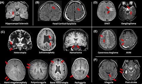 mri in epilepsy medical radiology Reader