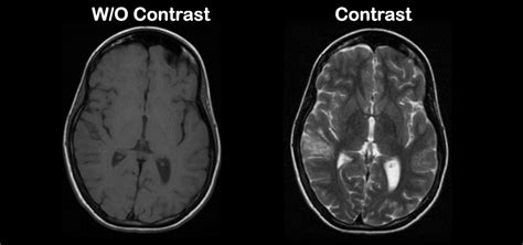 mri with and without contrast