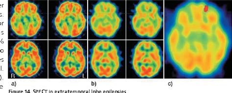 neuroimaging in epilepsy Doc